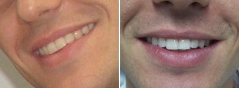 clareamento dental com semen