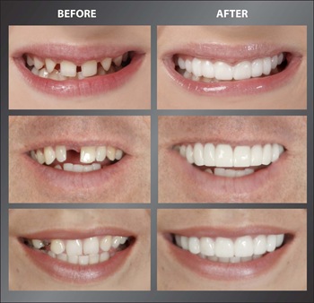 snap on smile 