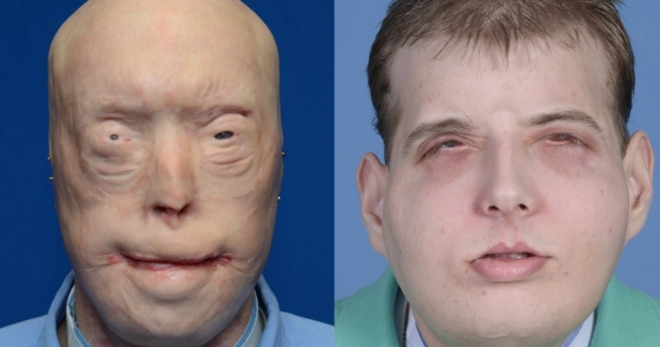 transplante-rosto-1