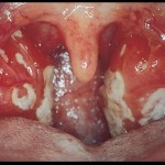 Mononucleose infecciosa