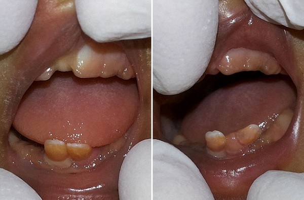 dentes-leite