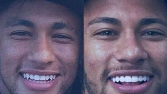 neymar-facetas-dentes