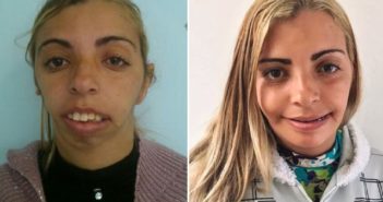 Ela era chamada de ‘monstro’, mas fez cirurgia após doações de dentistas