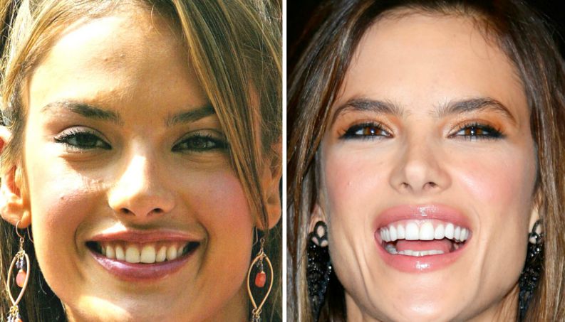 famosas antes depois dentista