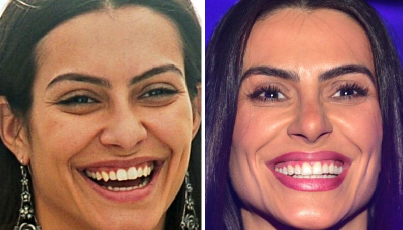 famosas antes depois dentista