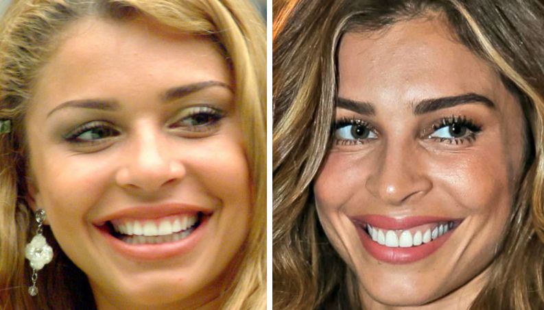 famosas antes depois dentista