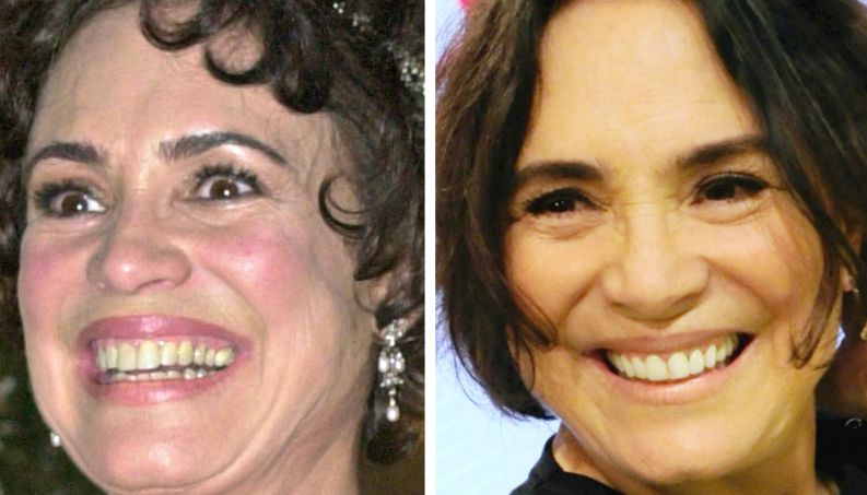 famosas antes depois dentista