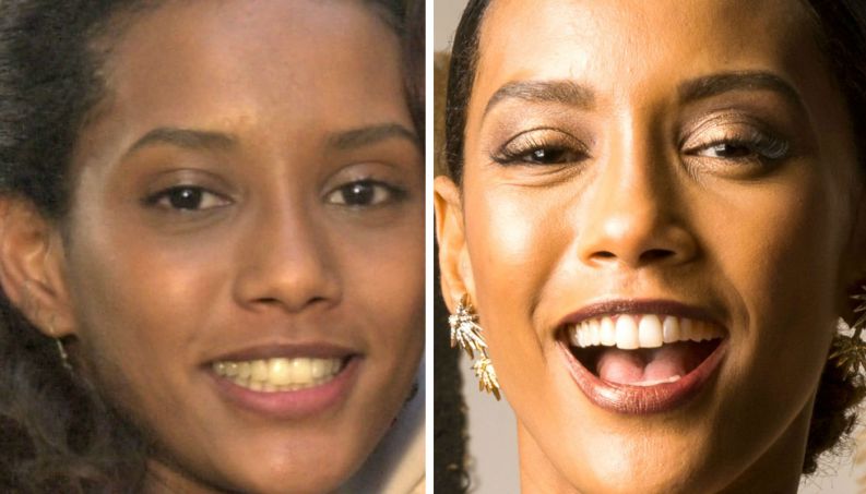 famosas antes depois dentista