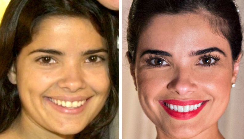 famosas antes depois dentista